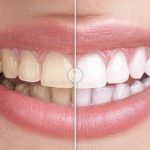 codecanyon-20493934-before-after-images-comparison-wordpress-plugin